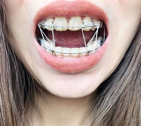 braces girlswithbraces clearbraces elastics powerchain braces girls dental braces