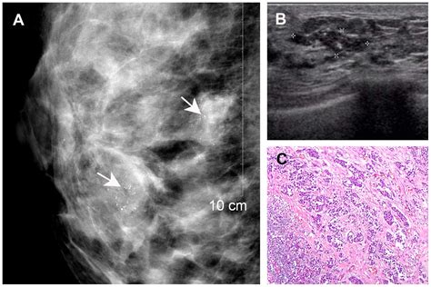 Comparison Of Mammography And Ultrasound In Detecting Residual Disease