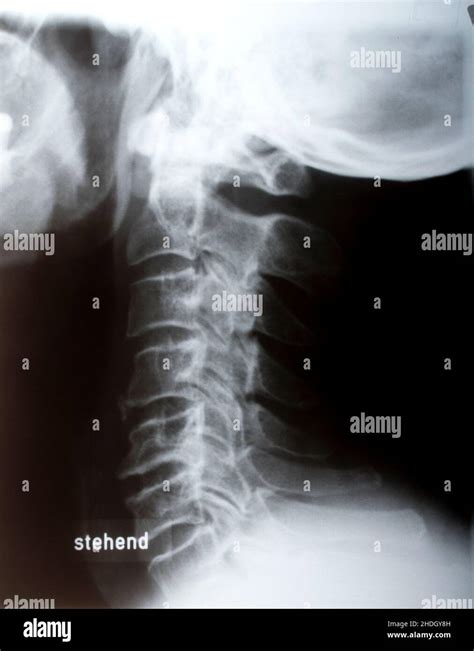 X Ray Image Injury Human Spine Cervical Spine Radiology X Rays