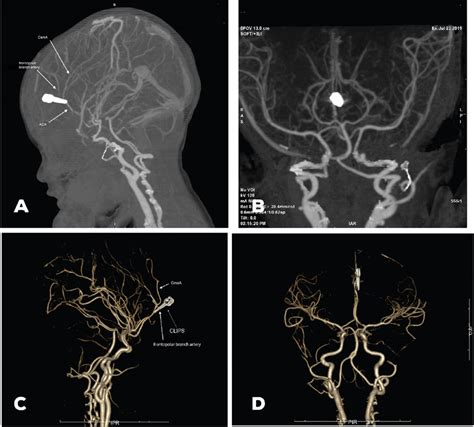 The Postoperative Ct Angiography Showed Clipping Of Aneurysm In Distal Download Scientific