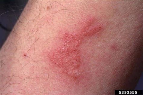 What Do Bed Bug Bites Look Like Pictures And Tips Nextgen Pest Solutions