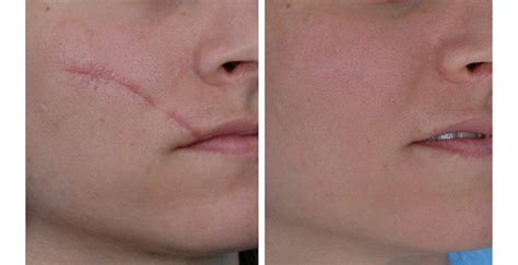 Scar Removal Cns Center Of Arizona And Medical Aesthetics