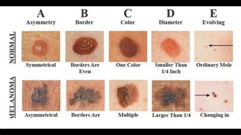 Understanding The Hidden Dangers Of The Deadliest Of Skin Cancers