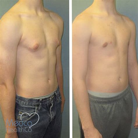 Gynecomastia Surgery Medco Healthco Stay Safe And Healthy