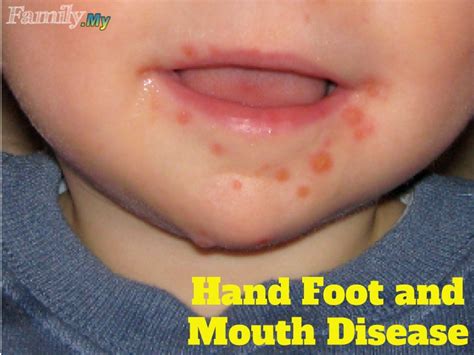 About hand, foot and mouth disease. Hand Foot and Mouth Disease | Malaysia Health Family ...