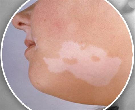 These Home Remedies Can Cure Vitiligo Easily