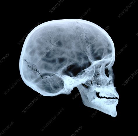 Childs Skull Stock Image P1200224 Science Photo Library