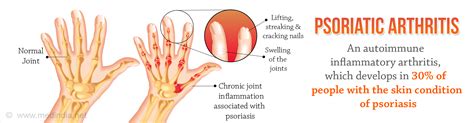 Psoriatic Arthritis Types Causes Risk Factors Diagnosis Treatment