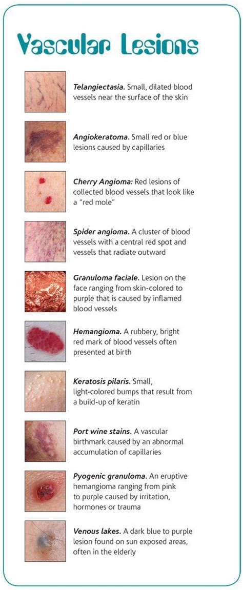 An Estheticians Guide To Vascular Lesions Beauty Tips Skin