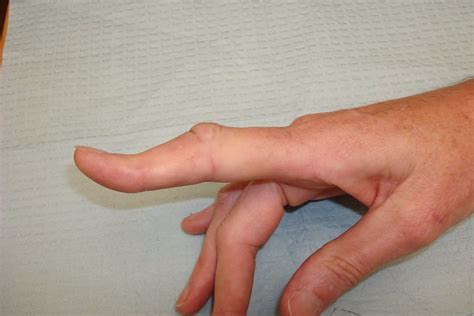 Boutonniere Finger Deformity From Tendon Injury
