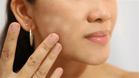 Manchas Blancas En La Cara Skingroup Dermatólogos