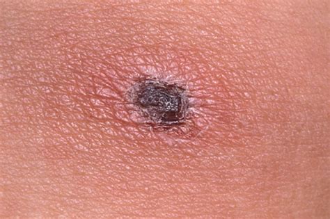 恙虫病是由恙虫病立克次体orientia tsutsugamushi（之前的 rickettsia tsutsugamushi）感染引起、以螨为传播媒介。 表现为发热、皮损、皮疹和淋巴结肿大。 恙虫咬伤与恙虫病-蔡晧东-财新博客-新世纪的常识传播者-财新网