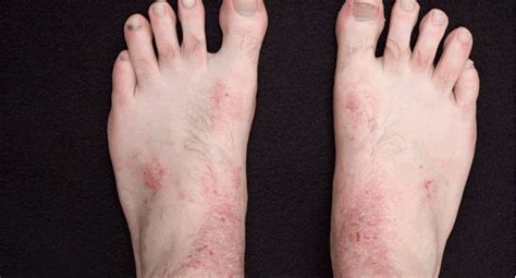 Skin Conditions Foot Health Podiatry Foot Health Podiatry