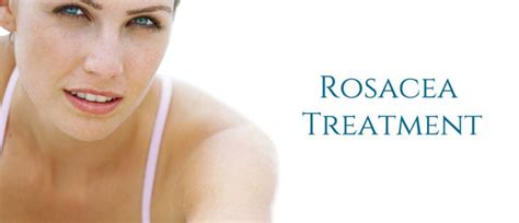 Rosacea Treatment Pictures Causes Diet Triggers 4 Women Daily Magazine