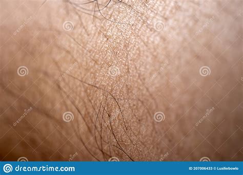 Close Up Cracked Skin From The Legs Stock Image Image Of Chronic