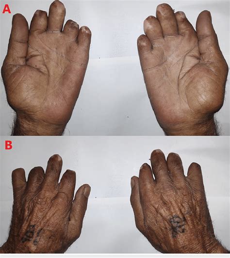Amputated Fingers Of Both Hands A And B With Intact Thumbs