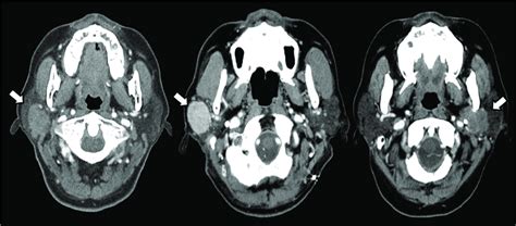 Contrast Enhanced Ct Images Of Parotid Gland Tumors Arrows In Three
