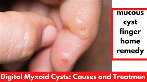 Mucous Cysts Of The Fingers Orthogate Vrogue Co