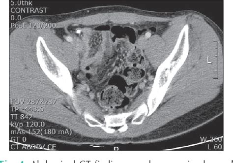 Figure 4 From Acute Appendicitis Caused By Foreign Body Ingestion
