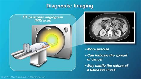 However, it can affect any breed. Pancreatic Cancer: Pathophysiology, Diagnosis and Staging ...