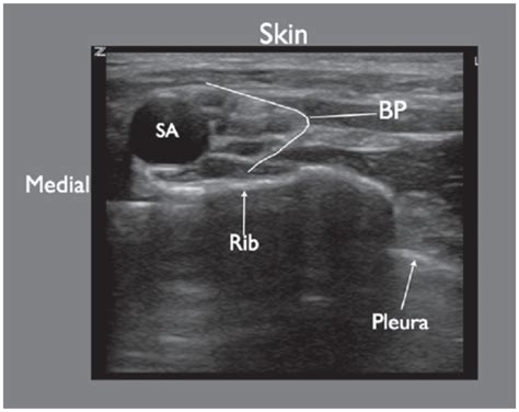Ultrasound Imaging Of The Supraclavicular Brachial Plexus Block