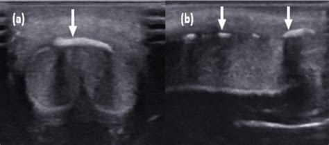 Cureus Peyronies Disease Presenting As Curvature Of The Penis A Case Report