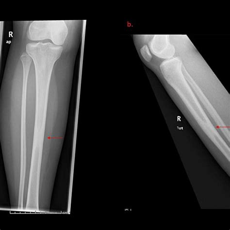 frontal a and lateral b radiographs of the proximal tibia and download scientific diagram