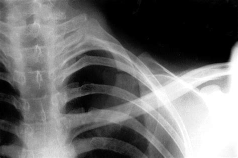 Isolated Fracture Of The First Rib Without Associated Injuries A Case Report Emergency