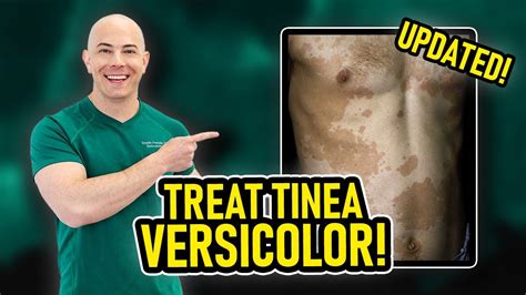 How To Treat Tinea Versicolor And Keep It From Coming Back