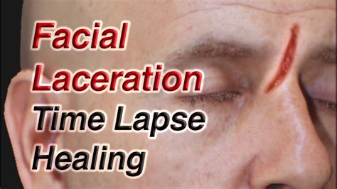 Facial Laceration Time Lapse Healing Via Secondary Intention Youtube