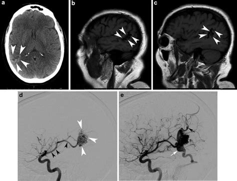 Brain Arteriovenous Malformations Radiology Key