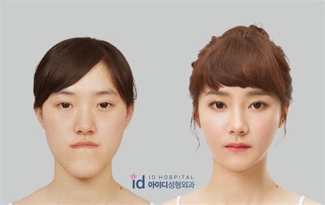 Id Hospital Korea Plastic Surgery Id Hospital Korea Our Patients Top Most Requested Surgery
