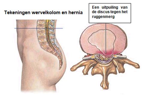 Hernia Symptomen Rug Symptomen