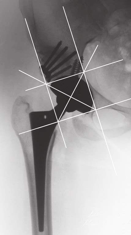 X Rays Of The Right Hip Before A And After B Total Hip