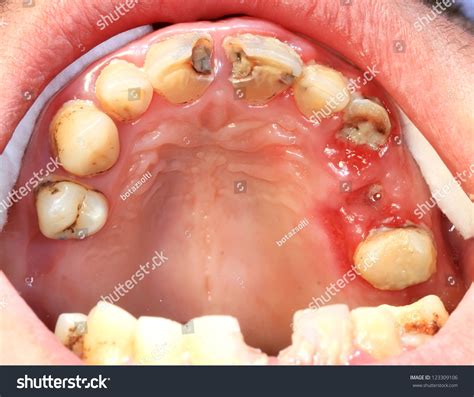 Mouth Inflammation Pictures Photos