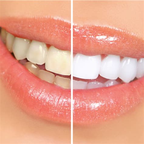 Diy Teeth Whitening 5 Brilliant Tips For Whiter Teeth That Work Lifestyle By Ps