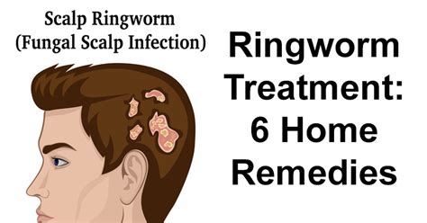 Ringworm Treatment Home Remedies For Humans
