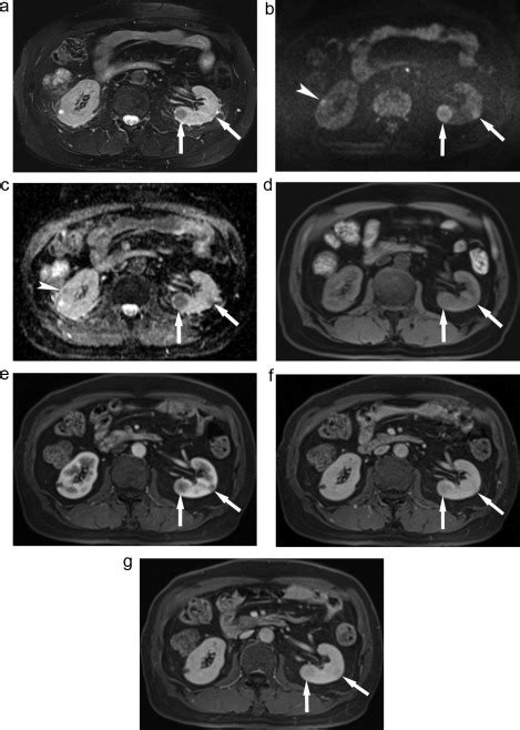 Igg4 Related Kidney Disease Mri Findings With Emphasis On The