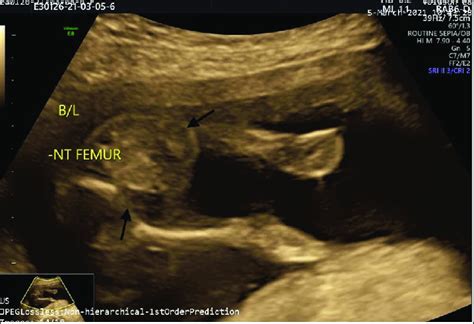 Antenatal Ultrasound Scan Of The Fetus At 18 20 Weeks At The Level Of