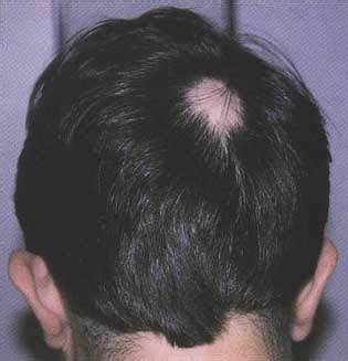 Evaluation and treatment of male and female pattern hair loss. Health Avenue: All About Alopecia Areata