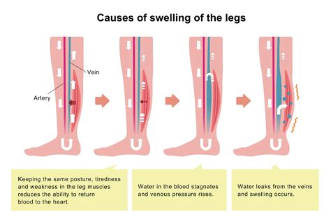 Vascular Calves