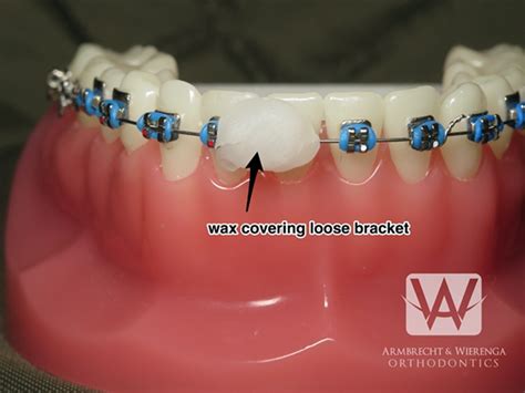 Braces Care Guide Frequently Asked Questions About Braces Grand