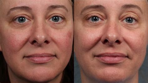 Excel V Laser Treatment Before And After Photos Patient 685 Louisville