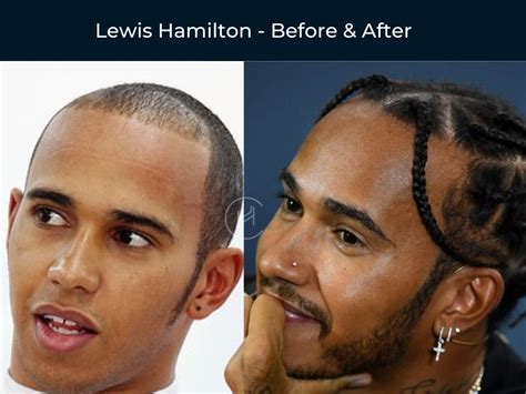 Celebrity Hair Transplants Before And After Photos