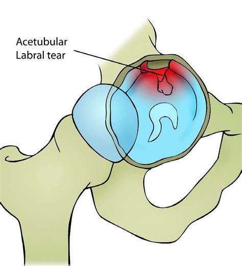 Hip Injury Acetabular Labral Tears El Paso Tx Doctor Of Chiropractic
