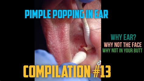 pimple popping in ear pimple popping this week compilation 13 youtube