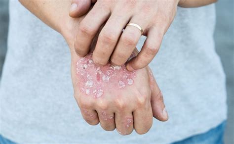 Da wikipédia, a enciclopédia livre. Psoriase pustulosa |Dr. Psoríase lista 5 causas e a solução