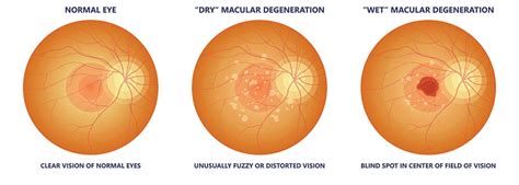 Macular Degeneration Memphis Eye Disease Collierville Southaven