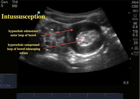 Intussusception Ultrasound Cases Info