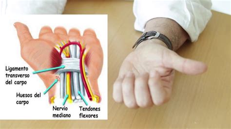 Sindrome Tunel Carpiano